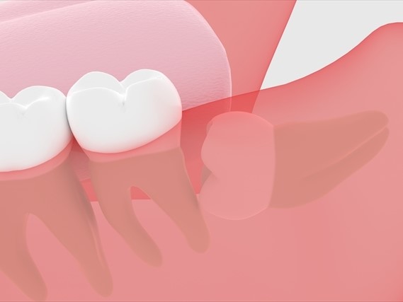 親知らずのイラスト