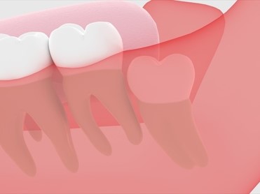 親知らずのイラスト